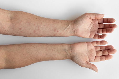 If Your Veins Are More Visible Than Before, Here’s What Your Body May Be Trying To Tell You